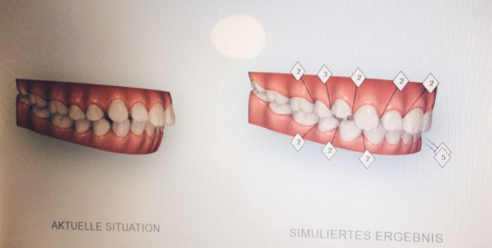 invisalign-unsichtbare-Zahnkorrektur-smilike-berlin-unsichtbare-Zahnspange